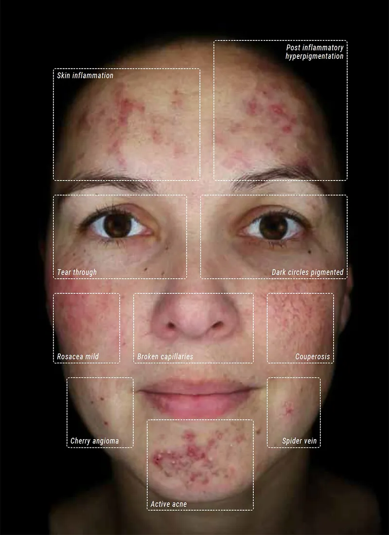How Diabetes Affects the Retina Alma IQ facial skin analysis in cross-polarized mode