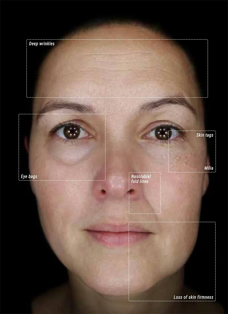 How Diabetes Affects the Retina Alma IQ facial skin analysis in daylight mode