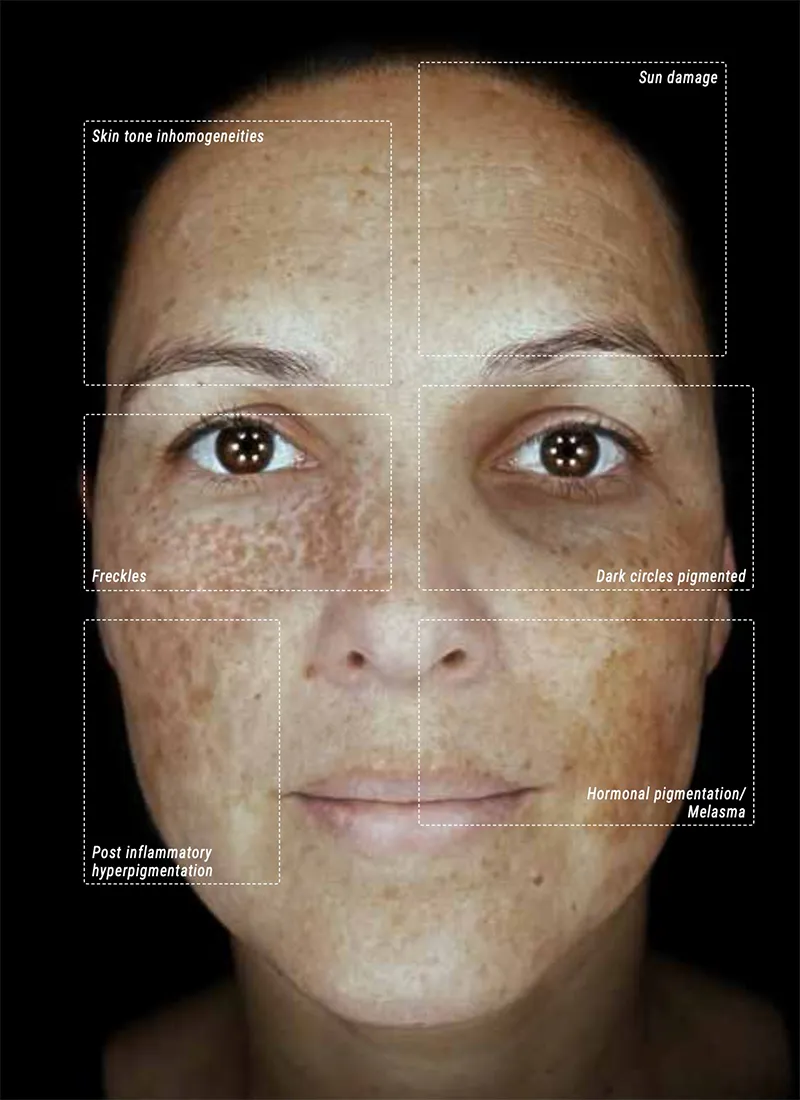 How Diabetes Affects the Retina Alma IQ facial skin analysis showing pigmentation