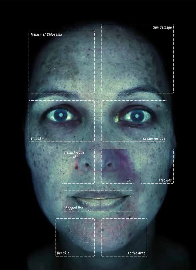 How Diabetes Affects the Retina Alma IQ facial skin analysis in true UV mode